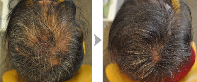 Hair Loss Clininc Thinning Hair Cure Hair Loss Treatment